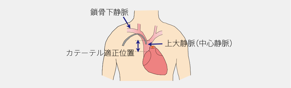 鎖骨下静脈上大静脈(中心静脈)とカテーテル適正位置の図