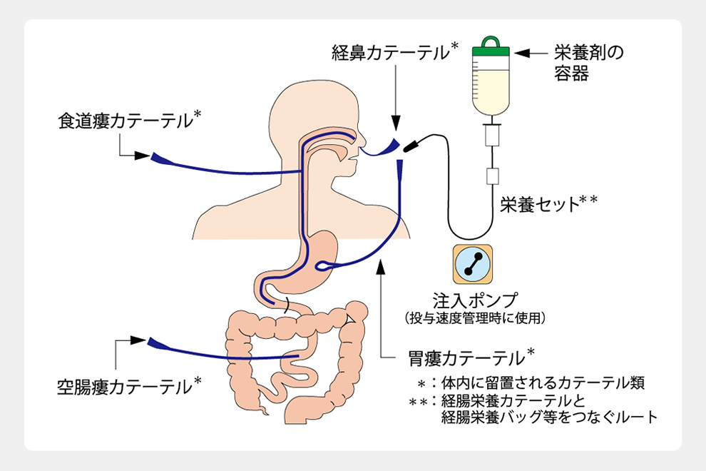 在宅経腸栄養の図解