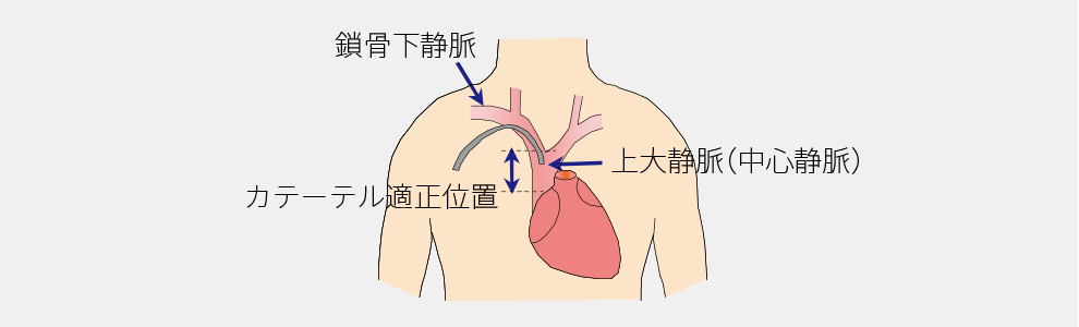 鎖骨下静脈上大静脈（中心静脈）とカテーテル適正位置の図